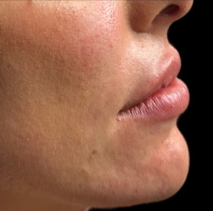 Lip Filler Before & After Patient #9573