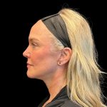 Facelift Before & After Patient #9519