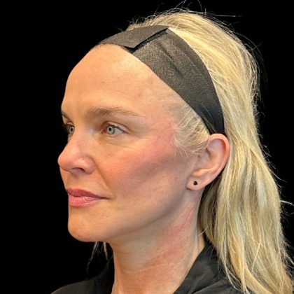Facelift Before & After Patient #9519