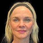 Facelift Before & After Patient #9519