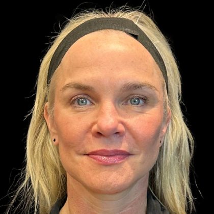 Facelift Before & After Patient #9519