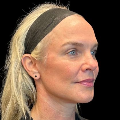 Facelift Before & After Patient #9519