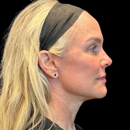 Facelift Before & After Patient #9519