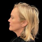 Facelift Before & After Patient #9519