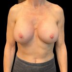 Breast Implant Exchange Before & After Patient #9000