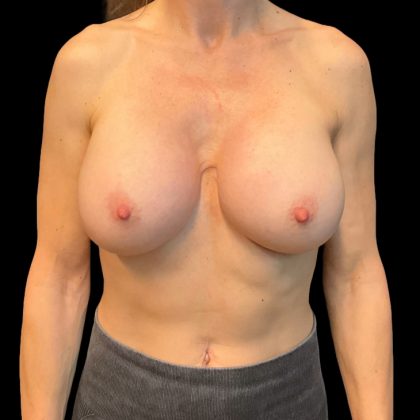 Breast Implant Exchange Before & After Patient #9000