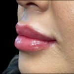 Lip Filler Before & After Patient #9530