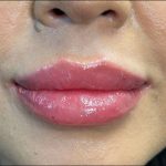 Lip Filler Before & After Patient #9530