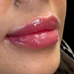 Lip Filler Before & After Patient #9530