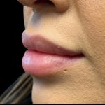 Lip Filler Before & After Patient #9530