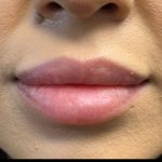 Lip Filler Before & After Patient #9530