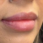 Lip Filler Before & After Patient #9530