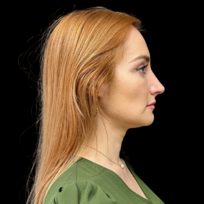 Rhinoplasty Before & After Patient #9602