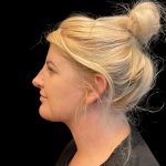 MyEllevate Before & After Patient #9501