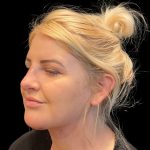 MyEllevate Before & After Patient #9501