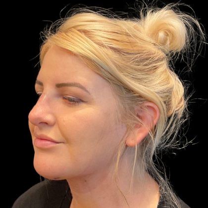 MyEllevate Before & After Patient #9501