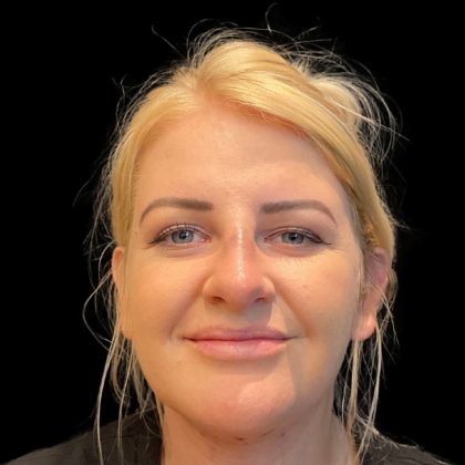 MyEllevate Before & After Patient #9501