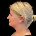 MyEllevate Before & After Patient #9501