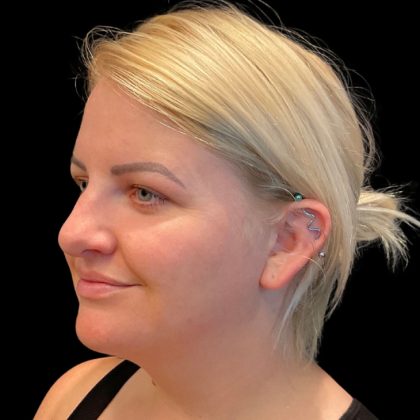 MyEllevate Before & After Patient #9501