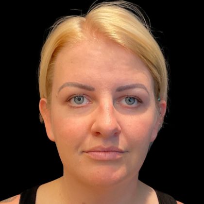 MyEllevate Before & After Patient #9501