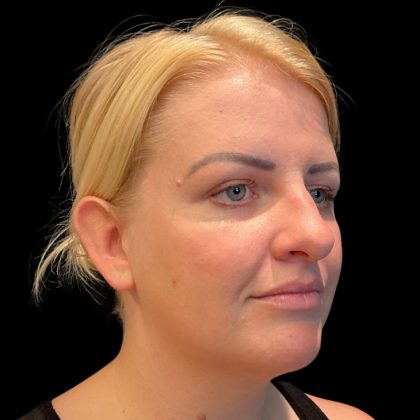MyEllevate Before & After Patient #9501