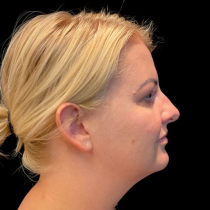 MyEllevate Before & After Patient #9501