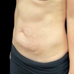Vivace Before & After Patient #9681
