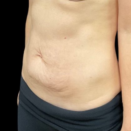 Vivace Before & After Patient #9681