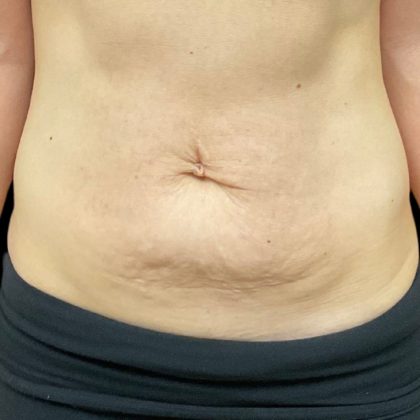 Vivace Before & After Patient #9681
