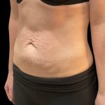 Vivace Before & After Patient #9681