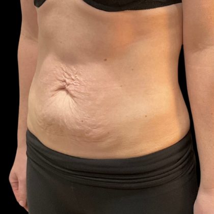 Vivace Before & After Patient #9681