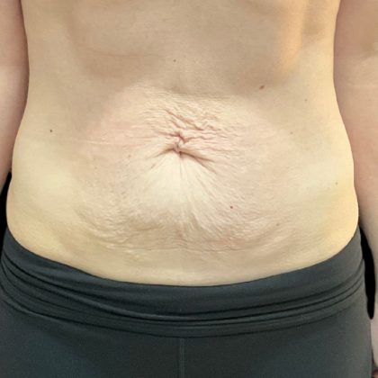 Vivace Before & After Patient #9681
