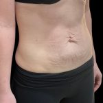 Vivace Before & After Patient #9681