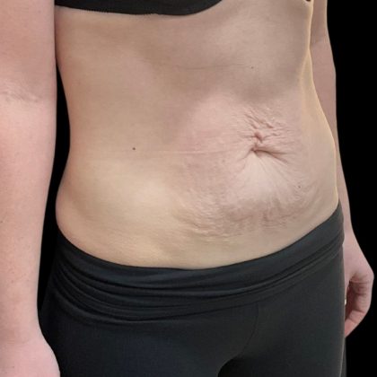 Vivace Before & After Patient #9681