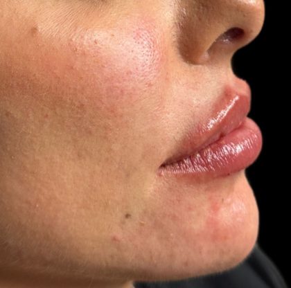 Lip Filler Before & After Patient #9573