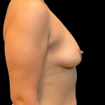 Breast Augmentation Before & After Patient #9049