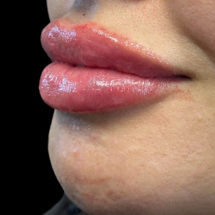 Lip Filler Before & After Patient #9512