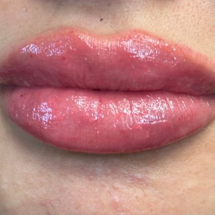 Lip Filler Before & After Patient #9512