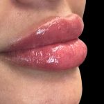Lip Filler Before & After Patient #9512