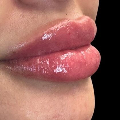 Lip Filler Before & After Patient #9512