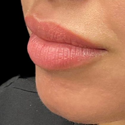 Lip Filler Before & After Patient #9512