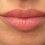 Lip Filler Before & After Patient #9512