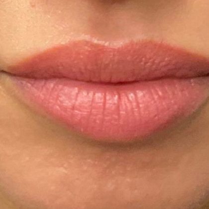 Lip Filler Before & After Patient #9512