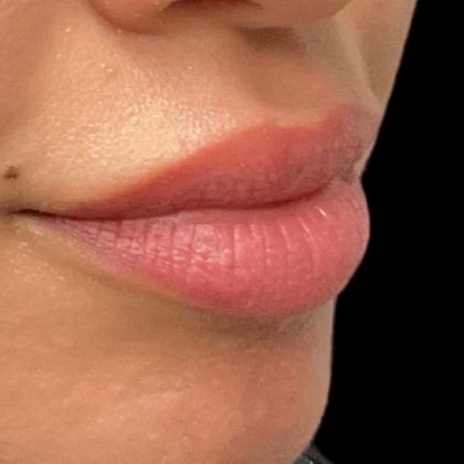 Lip Filler Before & After Patient #9512