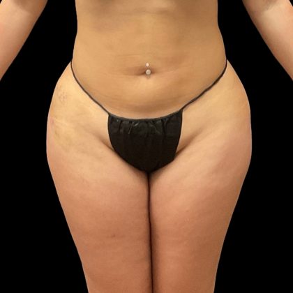 Brazilian Butt Lift Before & After Patient #8978