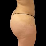 Brazilian Butt Lift Before & After Patient #8978