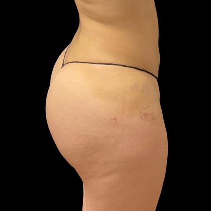 Brazilian Butt Lift Before & After Patient #8978