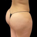 Brazilian Butt Lift Before & After Patient #8978