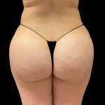 Brazilian Butt Lift Before & After Patient #8978