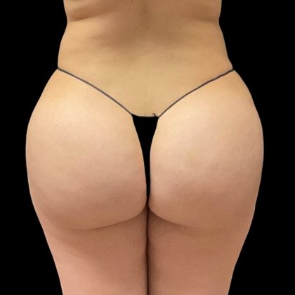 Brazilian Butt Lift Before & After Patient #8978